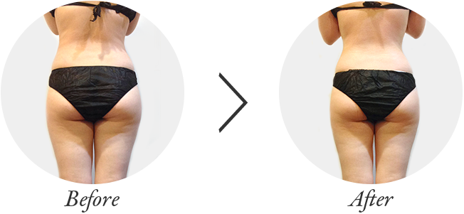 キャビテーション　ビフォアーアフター