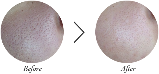 ハーブピーリング　ビフォアーアフター
